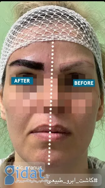 نمونه های کاشت ابرو در کلینیک اورانوس